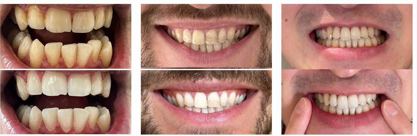 MAD Dental Care Teeth Whitening Powder Dentist Approved