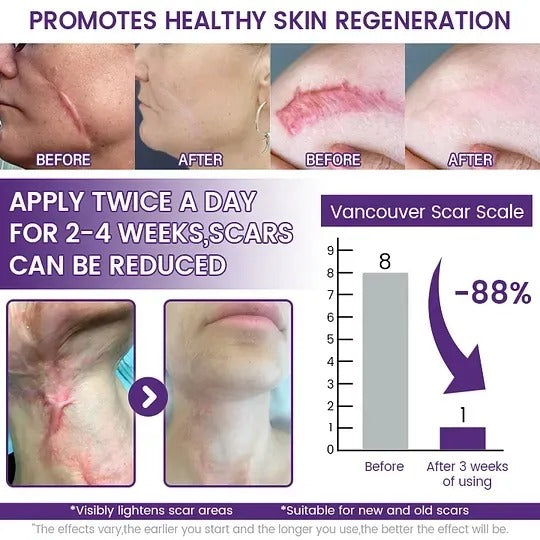 Timilk ScarVanisher Scar Gel 30g Regenscar Stem Cell