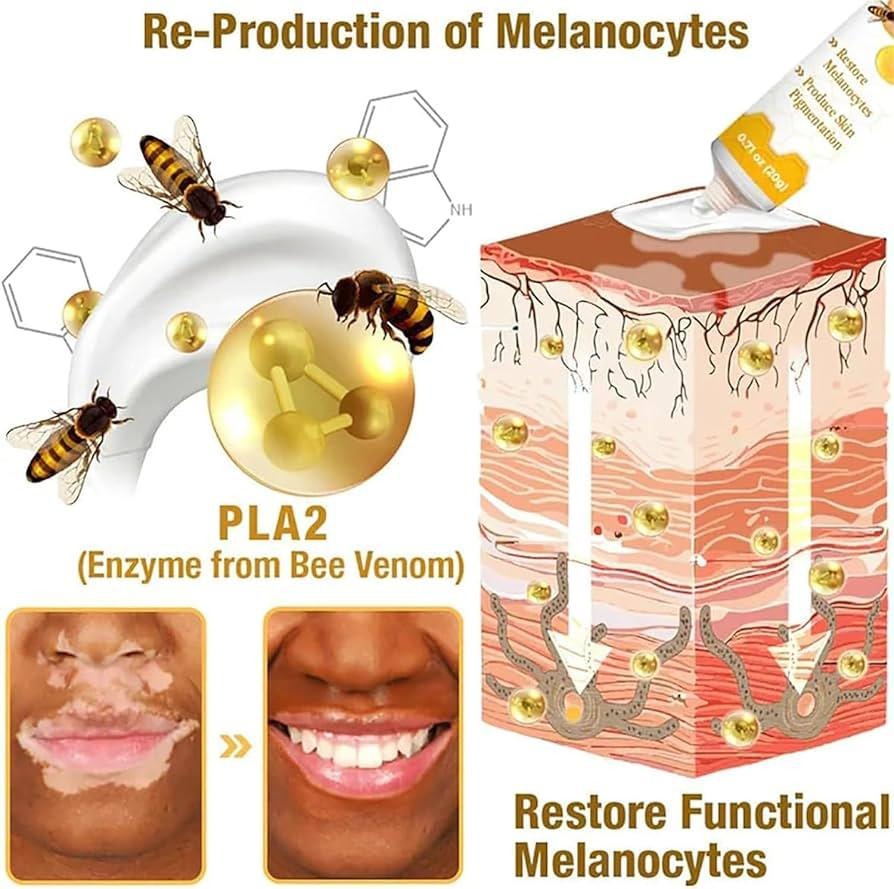 Vitiligo Cream Treatment Bee Venom Correcting Melanocytes VitiGO