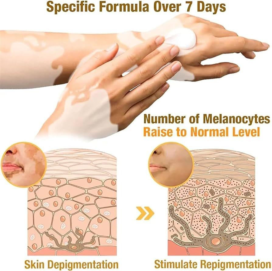 Vitiligo Cream Treatment Bee Venom Correcting Melanocytes VitiGO